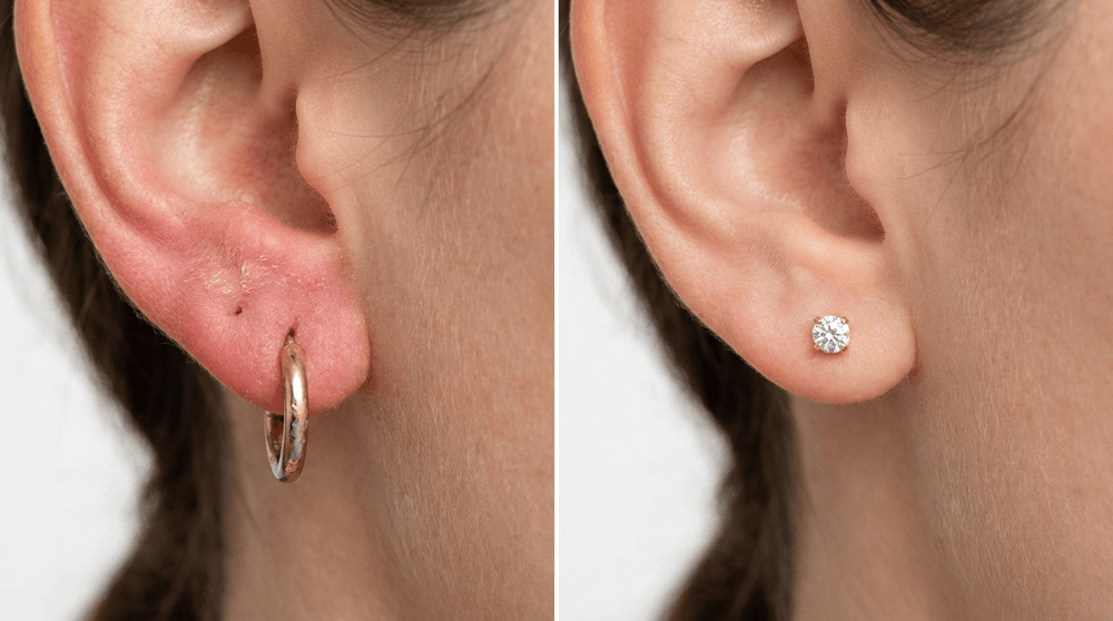 Nickel Allergy Symptoms: How to Tell if Your Earrings Are the Cause